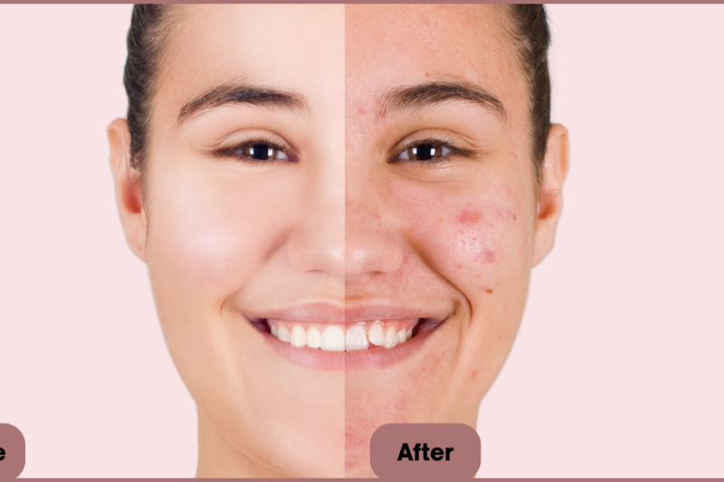 Exosome Therapy: The Future of Skin Regeneration