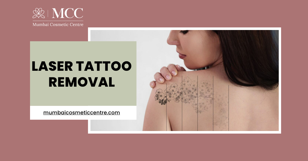 Laser Tattoo Removal
