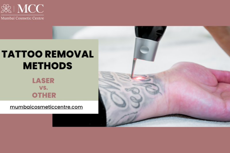 Laser vs. Other Tattoo Removal Methods: What Works Best?
