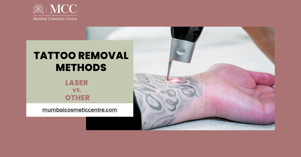 laser vs other tattoo removal methods