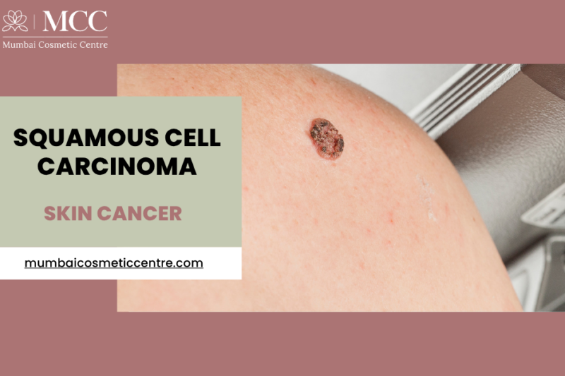 Skin Cancer: Squamous Cell Carcinoma Treatment