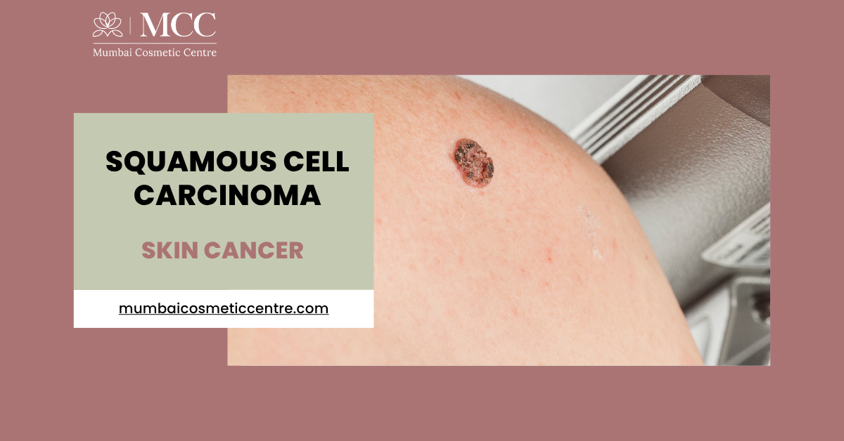 skin-cancer-squamous-cell-carcinoma-treatment.png