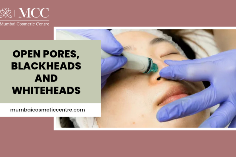 HydraFacial for Open Pores, Blackheads and Whiteheads