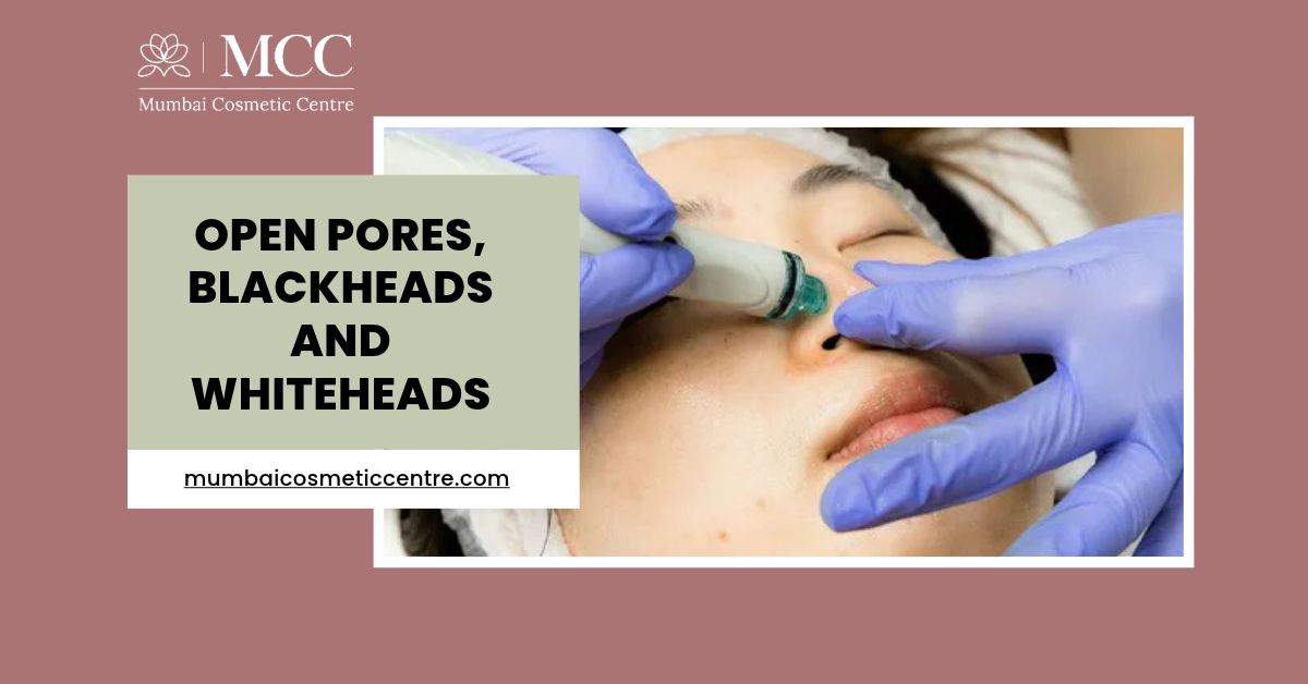 HydraFacial for Open Pores, Blackheads and Whiteheads