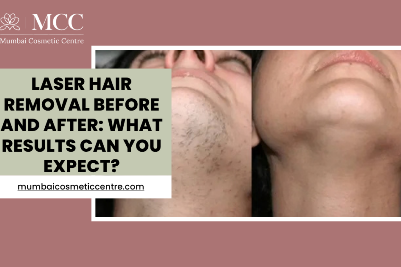 Laser Hair Removal Before and After: What Results Can You Expect?