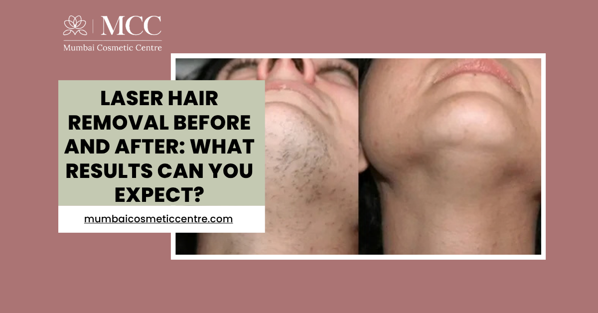 Laser Hair Removal Before and After: What Results Can You Expect?